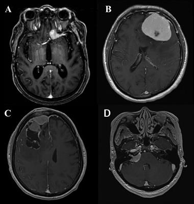 Frontiers | Meningioma: A Review Of Clinicopathological And Molecular ...